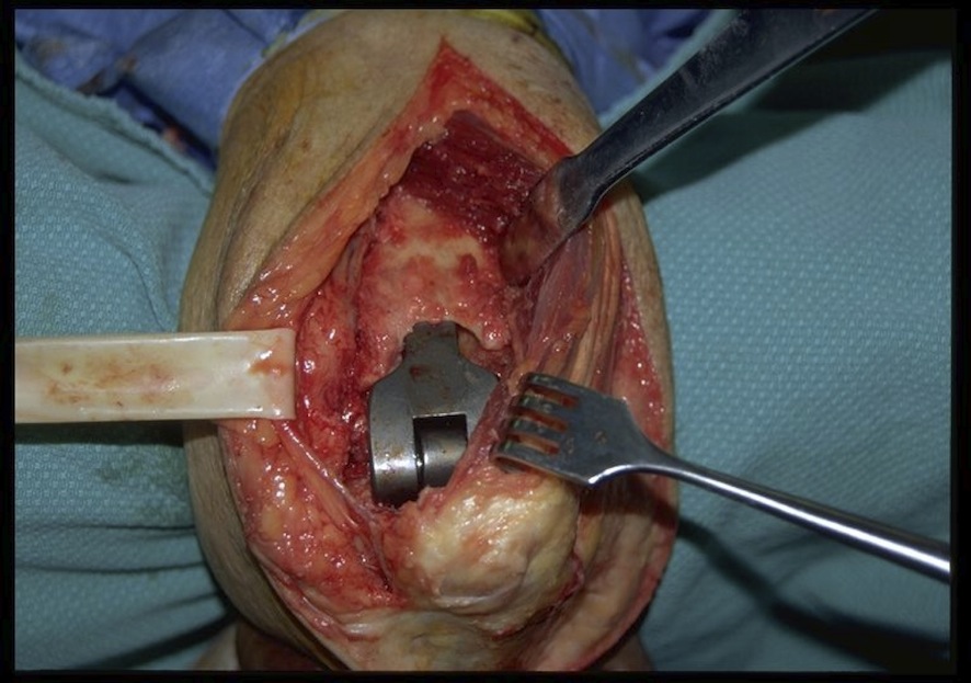 Total elbow loose humeral component